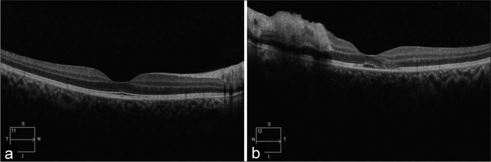 (a) Ocular coherence tomography of the right eye shows normal. (b) Left eye showing macular edema with discontinuity in the inner and outer retinal layer.