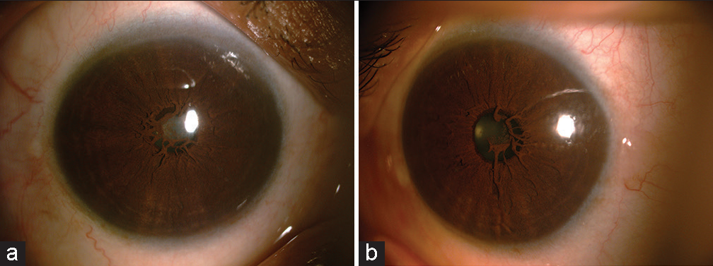 (a and b) Dense membrane occluding the pupillary area which is continuous with the collarette.