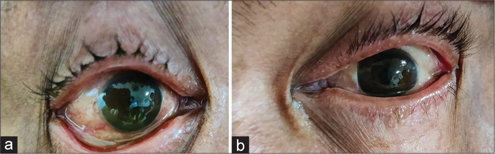 (a) Right eye and (b) left eye showing mild periorbital edema, circumciliary congestion with corneal epithelium defect.