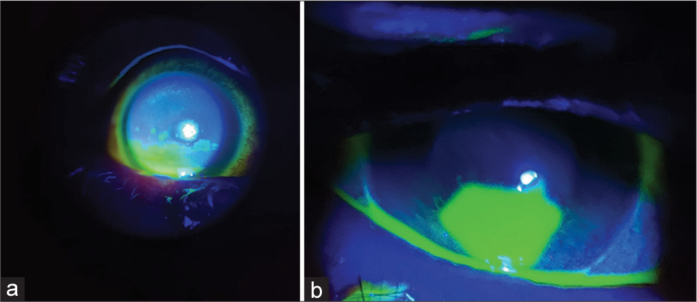 (a) Right eye and (b) left eye had corneal epithelial defects which stained heavily with fluorescein.