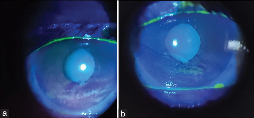 (a) Right eye and (b) left eye after 1 week of treatment.