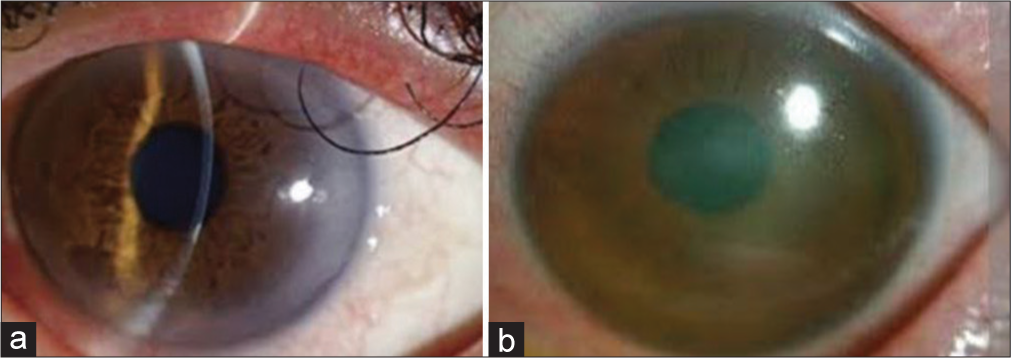 (a) Right eye and (b) left eye after 3 weeks of treatment.