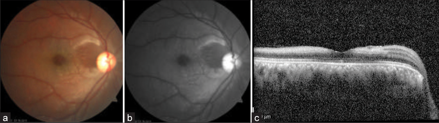 (a) Fundus photograph showing diffuse retinal whitening, (b) fundus fluorescein angiography showing irregular foveal hypo fluorescence, and (c) optical coherence tomography showing inner/middle retinal hyperreflectivity.