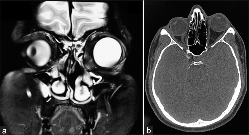 (a) T2-weighted fat-suppressed coronal magnetic resonance imaging of the orbits showing laterally rotated right globe with distortion of the medial wall of the right orbit post endoscopic sinus surgery. (b) Non-contrast axial computed tomography image of the orbits highlights the disinsertion of the medial rectus from the site of insertion on the right globe.