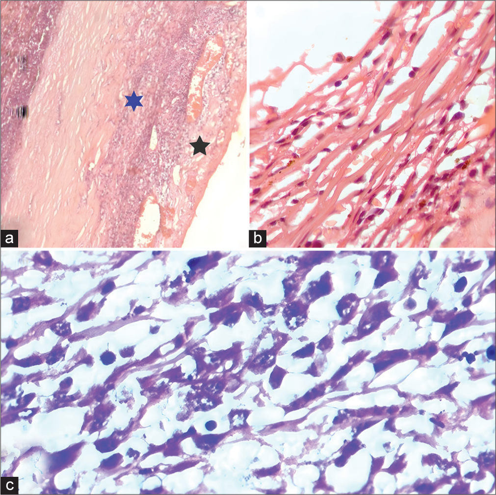 (a) Microscopic examination (ME) showing episcleritis (black star) and scleritis (blue star). (b) ME showing trabeculitis. (c) Showing well-differentiated paucicellular spindle cells.