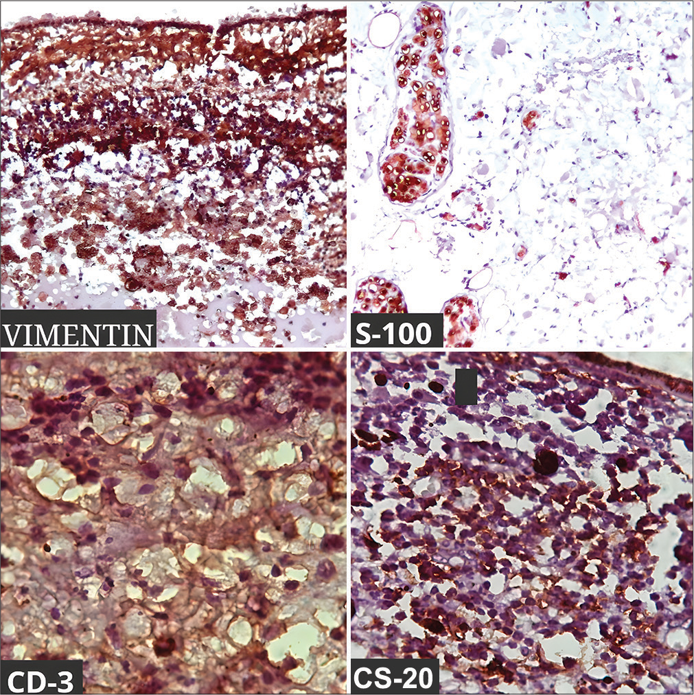 Immunohistochemical stain positive with Vimentin, S-100, CD-3, and CD-20.