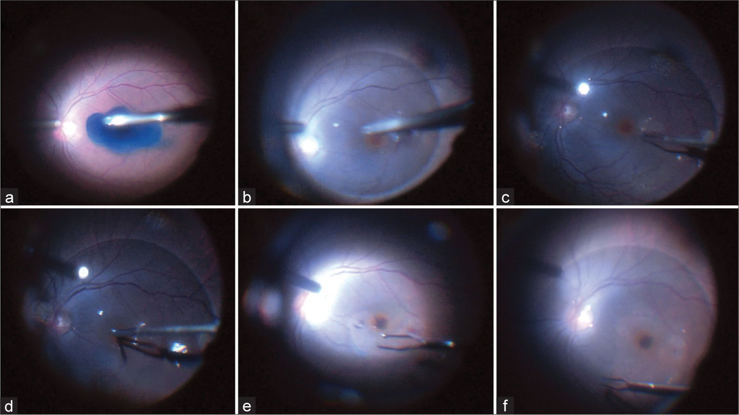 Step-by-step modified packing technique in large traumatic macular holes. (a) Internal limiting membrane (ILM) staining with brilliant blue G 0.025%. (b) perfluorocarbon liquid is applied in the macular area. (c) ILM peeling. (d and e) Packing the macular hole with the ILM. (f) Peripheral extension of the ILM peeling.