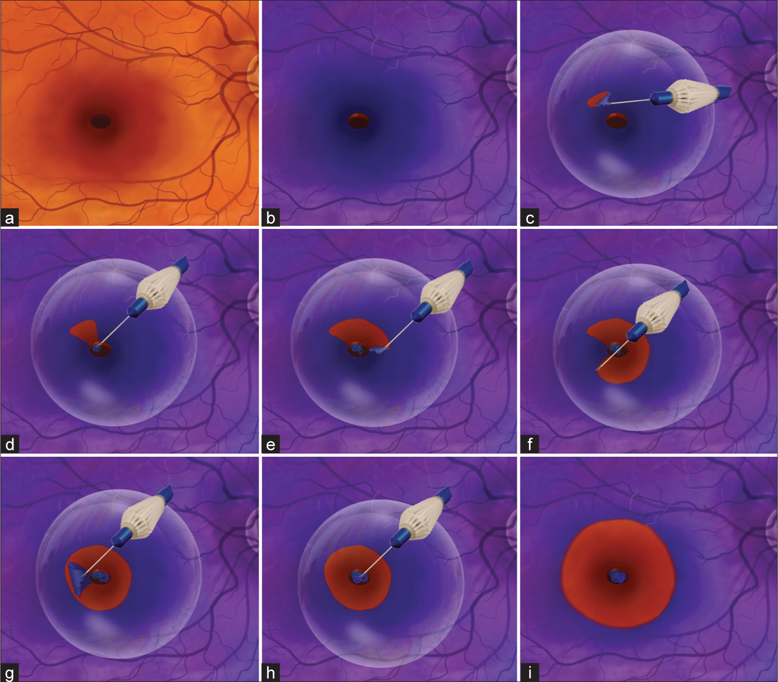 Modified packing technique in large traumatic macular holes scheme. (a) Macular hole (MH). (b) Internal limiting membrane (ILM) staining with brilliant blue G 0.025%. (c-f) ILM peeling under perfluorocarbon liquid. (g and h) Packing the MH with the ILM. (i) Peripheral extension of the ILM peeling.