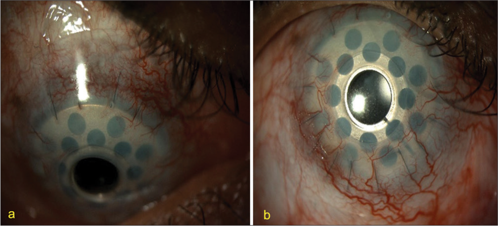 (a) Acceptable fit with Lotrafilcon B contact lens (Day 1) and (b) acceptable fit with Lotrafilcon B contact lens (Day 2).