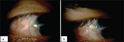 (a) 16.5 mm diameter scleral lenses (SL) impinging on the pinguecula and (b) 18.5 mm diameter SL impinging on the pinguecula.