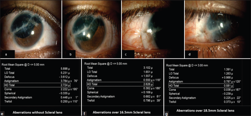 Aberrations with and without scleral lens. (a) Traumatic aniridia with corneal scar, (b) Eye fitted with 16.5 mm scleral lens, (c) Eye fitted with 16.5 mm scleral lens resting on pinguecula, (d) 18.5 mm scleral lens covering the pinguecula, (e) Aberrations without scleral lens, (f) Aberrations over 16.6 mm scleral lens, (g) Aberrations over 18.5 mm scleral lens.