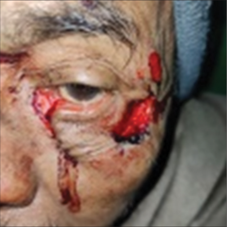 Left eye lower lid canalicular tear along with periorbital skin abrasion.