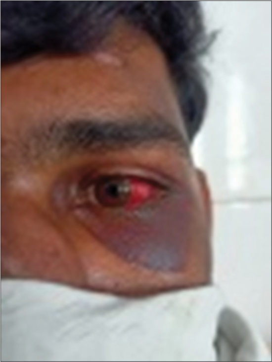 Left eye subconjunctival hemorrhage with periorbital ecchymosis.