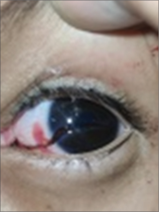 Sclerocorneal perforation- open globe injury.