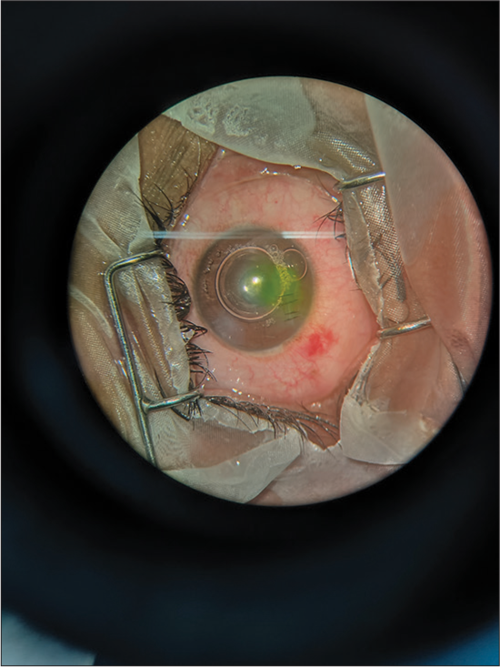 Corneal perforation repair done by suturing.