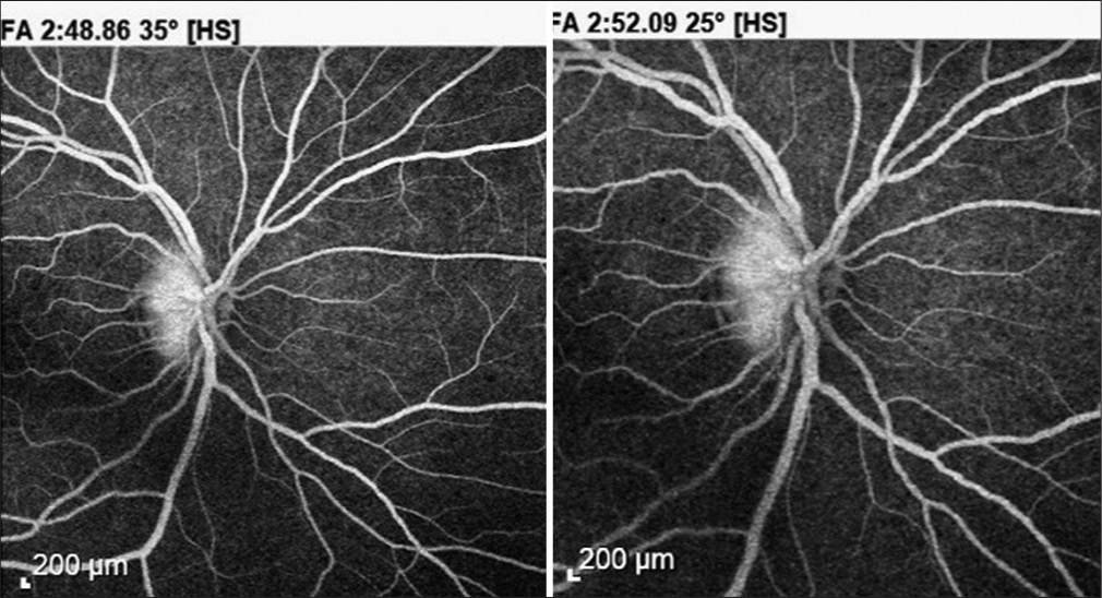 Fluorescein angiography confirmed leakage from the optic nerve in late phases.