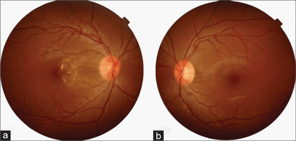 Fundoscopy of the right eye (a) shows optic nerve edema and resolution of subretinal fluid, showing a macular star due to intraretinal exudates. (b) with no pathological signs in the left eye.