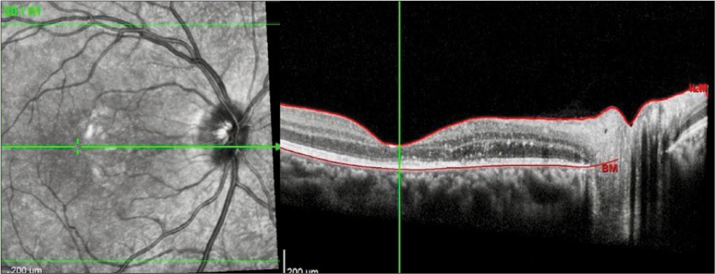 Optical coherence tomography of the right eye demonstrates the resolution of the optic nerve head edema, the subretinal fluid, and the new exudates deposited in the Henle’s layer.