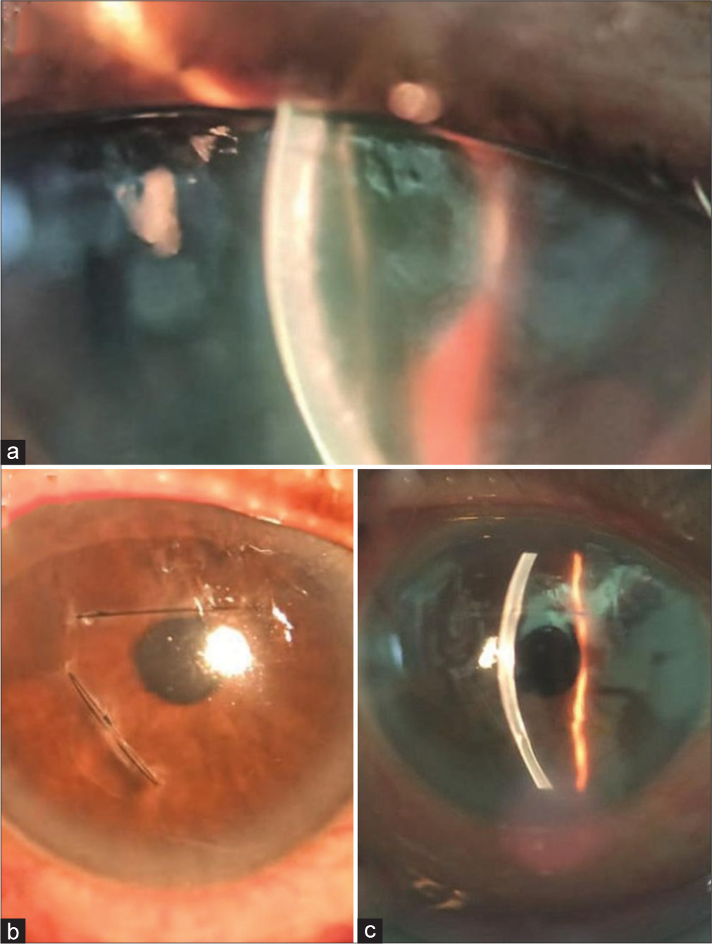 Pre-operative and post-operative image (a) pre-operative image showing non-planar Descemet membrane (DM) detachment (b) Post-operative image showing corneal sutures placed in the superior half and mid periphery temporally (c) Post-operative slit-lamp image showing attached DM.