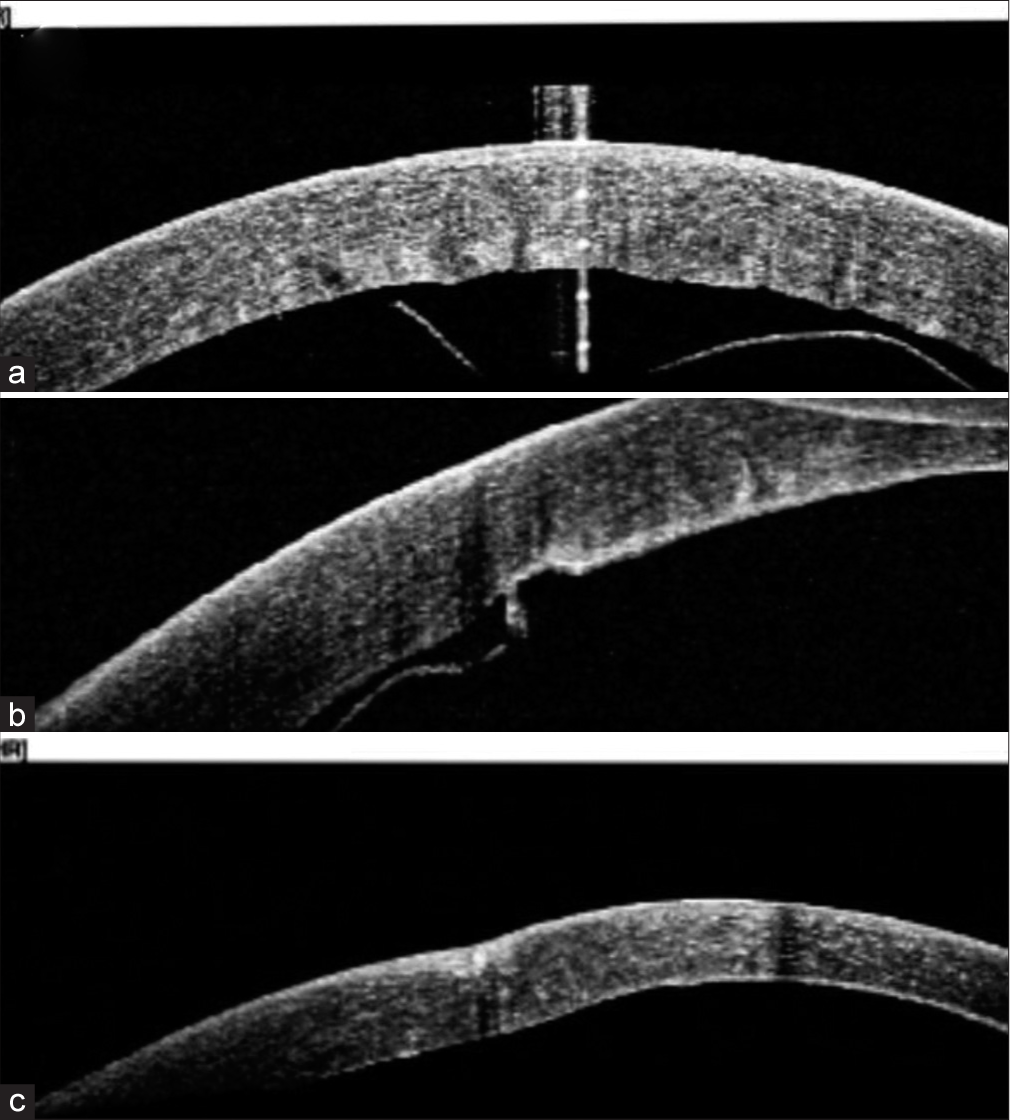 Anterior segment optical coherence tomography (ASOCT) images (a) pre-operative AS-OCT image showing central curled up Descemet membrane (DM) detachment (b) Postoperative day 1 AS-OCT image showing inferior residual detachment (c) Post-operative AS-OCT image at 1 month showing attached DM.