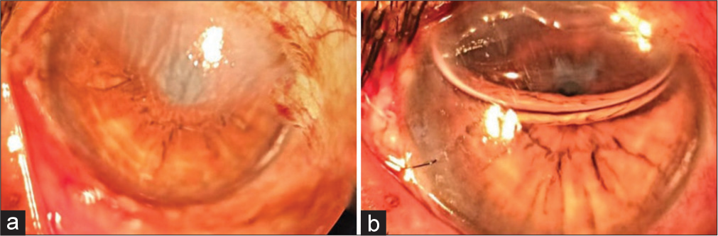Pre-operative and post-operative images (a) pre-operative slit-lamp image showing corneal edema in the superior part and (b) post-operative image showing clear cornea and air bubble in situ