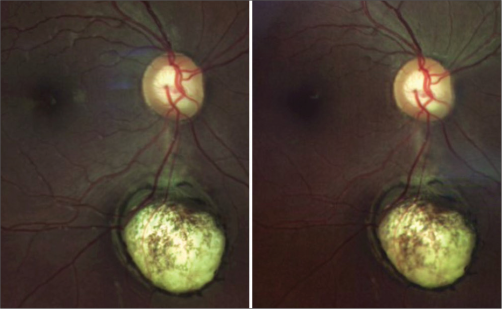 Stereoscopic fundus photograph of the right eye. Chorioretinal coloboma and its depth, extension, and location are highlighted 2.2 mm below the optic disc.
