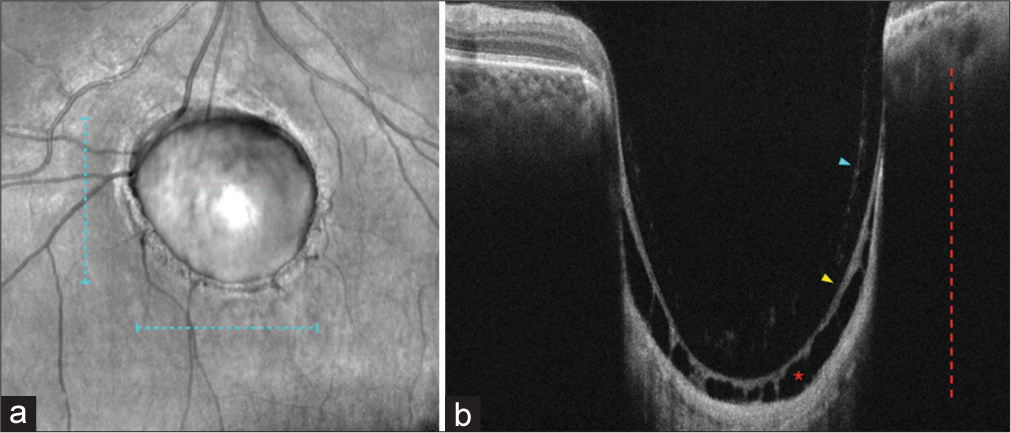 (a) Infrared image shows coloboma dimensions: Width 3417 µm (blue dashed line) and height 3173 µm (blue dashed line). (b) Spectral-domain optical coherence tomography scan reveals coloboma length 1540 µm (red dashed line), posterior hyaloid (blue arrowhead), intercalary membrane (yellow arrowhead), and degenerative cavitations (red asterisk).