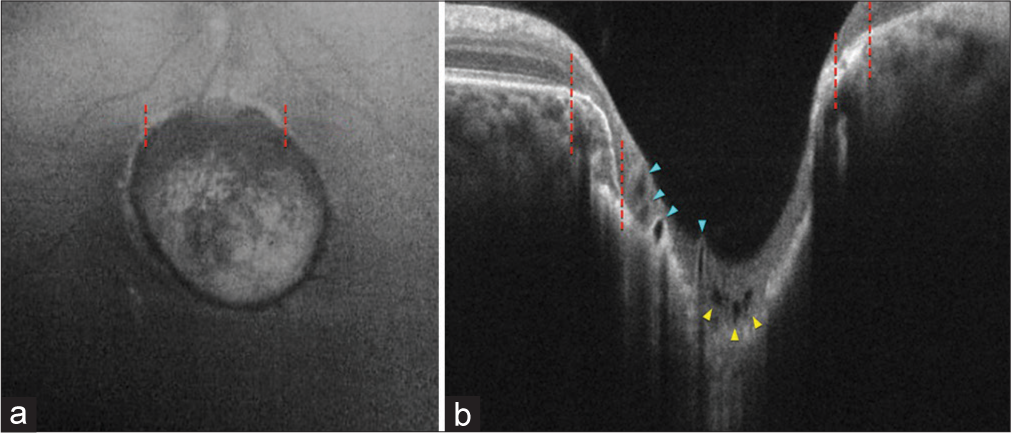 (a) Fundus autofluorescence (FAF) reveals a hypoautofluorescence coloboma with a surrounding hyperfluorescent halo (red dashed lines). (b) Spectral-domain optical coherence tomography shows retinal atrophy with intact retinal pigment epithelium (red dashed lines), corresponding to the hyperfluorescent halo in FAF and hyporeflective foci with/without shadows (blue/yellow arrowheads), representing retinal vessels.