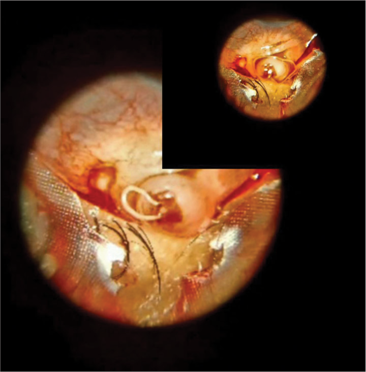 Montage of intraoperative image of live filarial worm wriggling out.