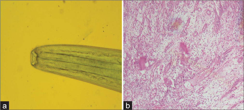 (a) Microphotograph of wet mount preparation of the head end of the parasite with surface striations in fluorescein stain (×40). (b) Microphotograph of Hematoxylin and Eosin stained section showing proliferation of vascular channels with inflammatory cells (×20).