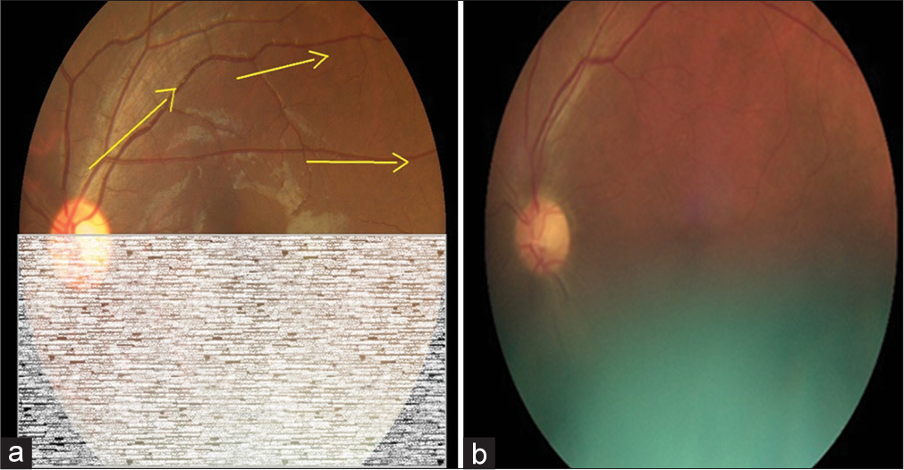 Step 2: Continue tracing through the superior temporal vessels arcade for visibility of vessels as a measure of image quality (Yellow arrows depict the suggested direction of tracing vessels on a retinal image). (a) Schematic diagram for 50% gradability classification, (b) Actual image of 50% gradable.