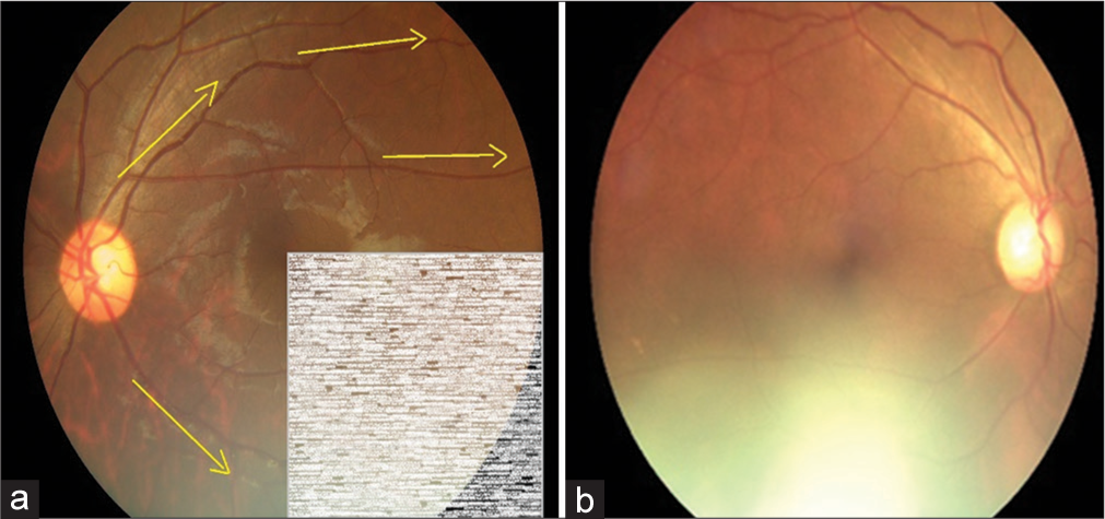 Step 3: Trace through the inferior nasal vessels and inferior temporal vessels for visibility of vessels as a measure of image quality (Yellow arrows depict the suggested direction of tracing vessels on a retinal image). (a) Schematic diagram for 75% gradability classification, (b) Actual image of 75% gradable.