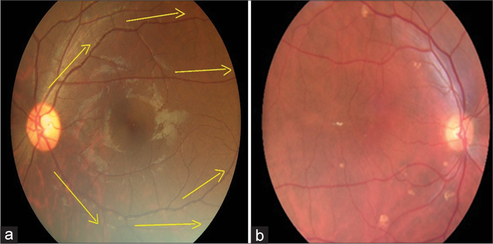 Step 4: Continue tracing through the inferior temporal vessels arcade for visibility of vessels as a measure of image quality (Yellow arrows depict the suggested direction of tracing vessels on a retinal image). (a) Schematic diagram for 100% gradability classification, (b) Actual image of 100% gradable.