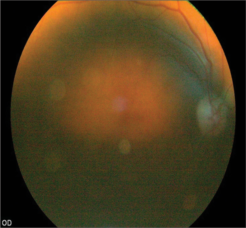 Fundus image of a patient with lens opacity.