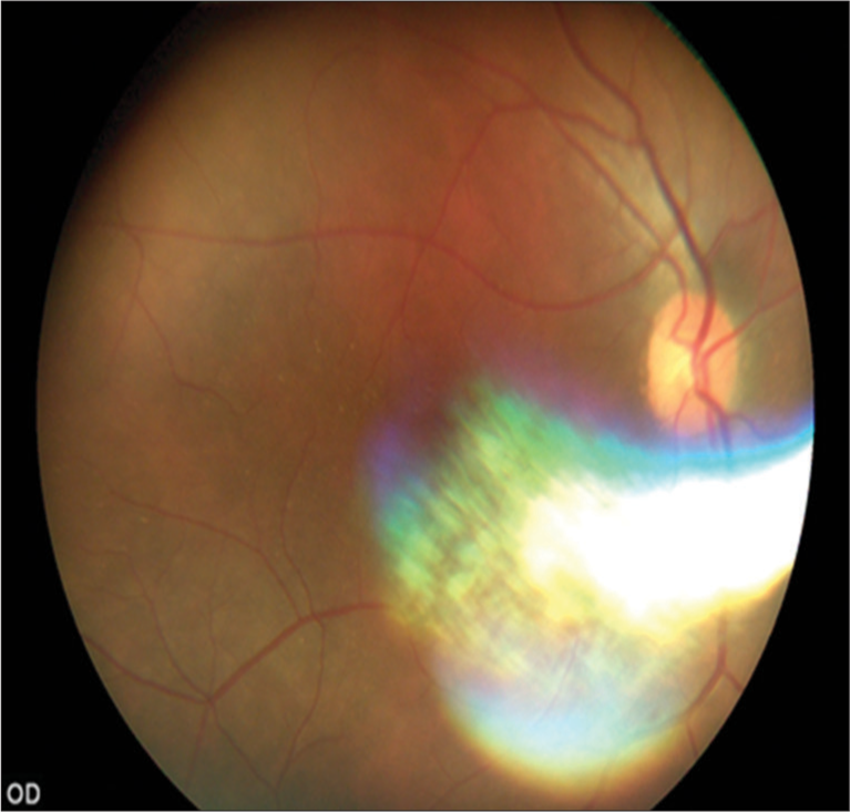 Fundus image of a pseudophakic patient.