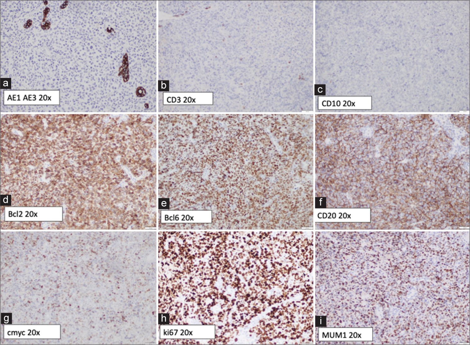 (a) Tumor cells negative for anticytokeratin monoclonal antibodies (AE1 and AE3), excluding a carcinoma. (b) Tumor cells negative for CD3. (c) Tumor cells negative for CD10. (d) Tumor cells positive for BCL2 (>70%). (e) Tumor cells negative for B-cell lymphoma (BCL6). (f) Tumor cells staining positive for CD20. (g) About 40-50% of the tumor cells are weakly positive for c-myc. (h) The Ki-67 proliferative index is variable, reaching up to 50% in some areas, which could be due to suboptimal tissue preservation. (i) Tumor cells positive for MUM1 (Multiple Myeloma Oncogene 1).