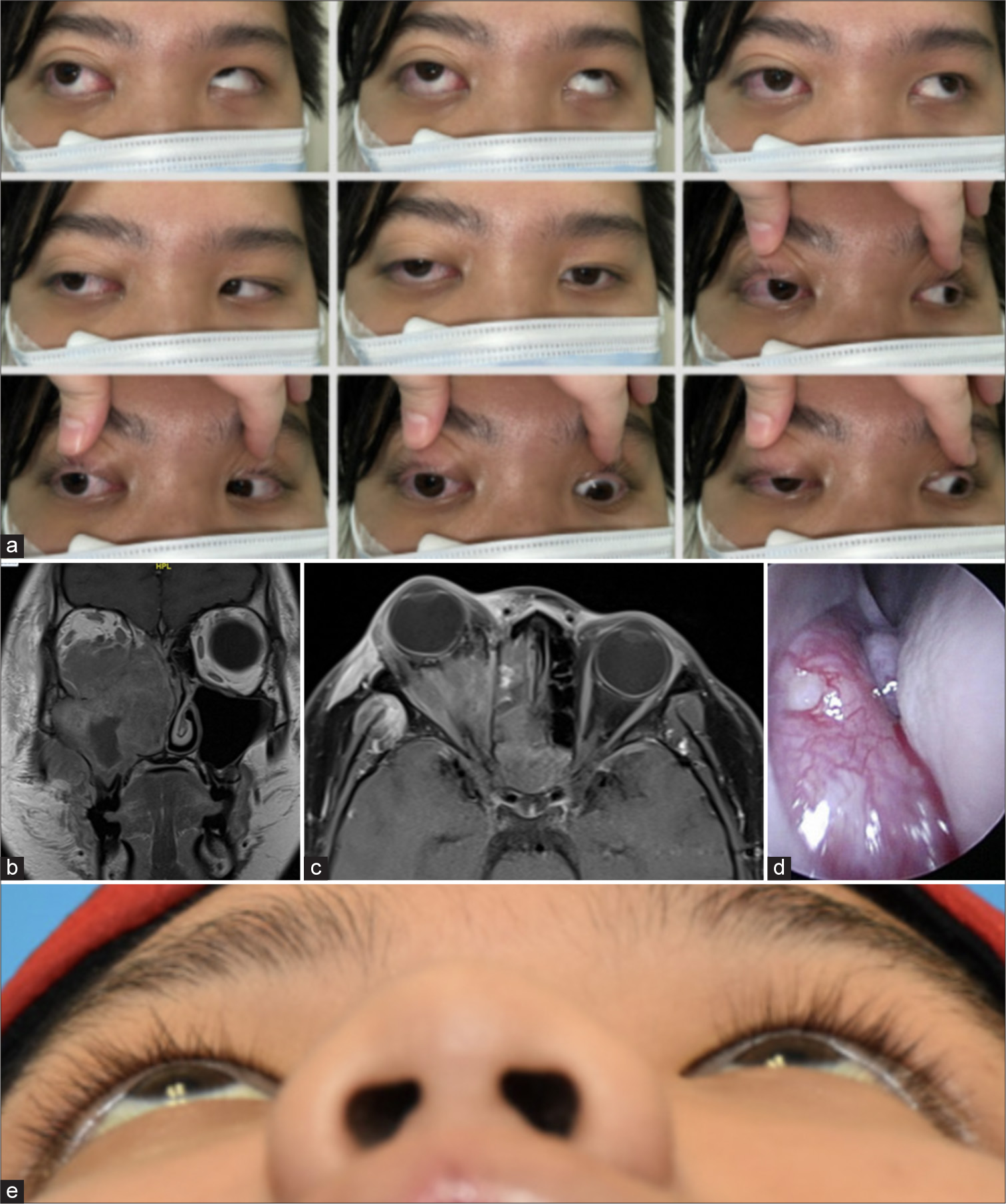 (a) 9-gaze photo shows limitation of left eye in all directions. (b and c) Magnetic resonance imaging of the orbits (with contrast) coronal and axial cuts– hyperintense mass of right maxillary sinus extending into lateral nasal wall and ethmoidal spaces, with irregular infiltration or bony erosion. The mass invades the medial, inferior, and lateral recti muscles. (d) Nasoendoscopy revealed a fleshy mass at middle and inferior meatus. (e) Worms eye view demonstrating improvement in proptosis.