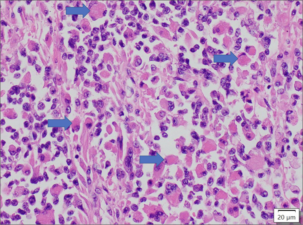 Sheets of rhabdoid cells with eosinophilic cytoplasm. The blue arrows depict some of the nuclei of the tumour cells were being pushed to one side. 400x, haematoxylin and eosin stain