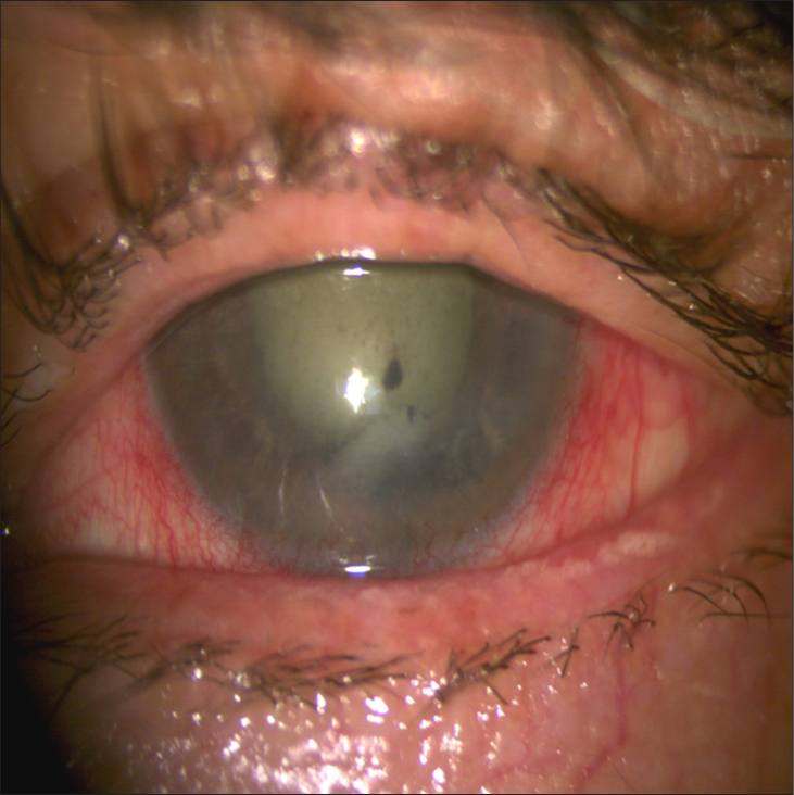 Slit-lamp photography of the left eye showing ciliary injection, mild corneal edema, anterior chamber reaction, keratic precipitates, and nuclear sclerosis.