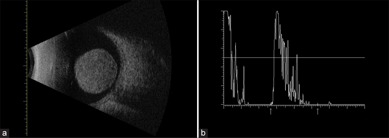 (a) B-scan ultrasonography showing a large homogeneous mushroom-shaped mass located in the posterior pole arising from choroid. The size of the tumor measured by ultrasonography was of 12.5 mm in thickness and the largest basal dimension was 5.68 mm. Additional findings include orbital shallowing and choroidal excavation. (b) A-scan ultrasonography showing low-medium reflectivity.