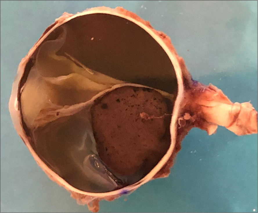 Gross appearance of the tumor. Mass arising from the choroid at the posterior pole with extension to the juxtapapillary area, measuring 9 mm at its base and 11 mm in height. Complete detachment of the neurosensory retina, accompanied by serous subretinal fluid.