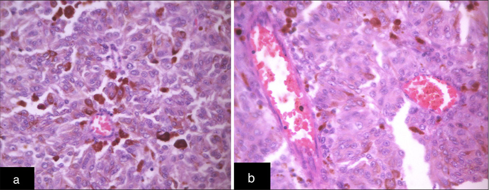 (a) Pathologic section (Hematoxylin and Eosin [H&E], ×40) showing clusters of compact epithelioid cells admixed with melanophages. (b) Pathologic section (H&E, ×40) showing randomly disposed epithelioid cells admixed with small vessels.