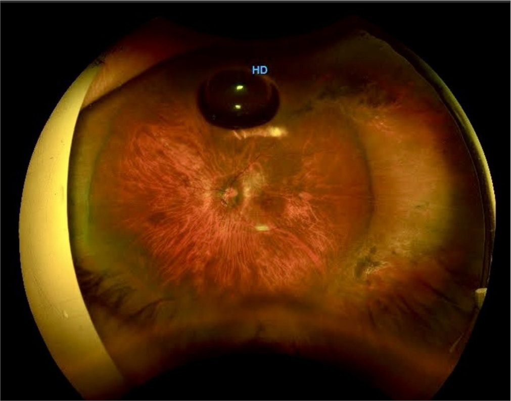 Final best-corrected visual acuity of 20/60 at 2 months postoperatively.