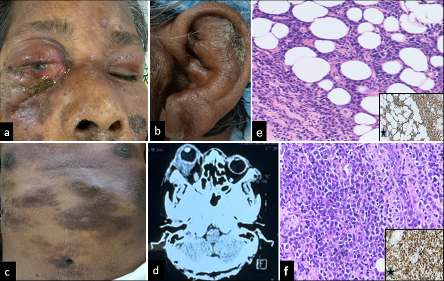 (a) Clinical photo showing a frozen globe due to tense orbital cellulitis and indurated skin in the periorbital area. (b and c) Multiple erythematous raised, plaque-like lesions over the ear lobule, trunk, and abdomen suggestive of systemic spread of disease. (d) Axial computed tomography scan is suggestive of diffuse soft-tissue mass surrounding the globe in the intraconal and extraconal spaces. (e) Histopathology of skin lesion biopsy hematoxylin and eosin (H&E) stain ×20 showing atypical lymphoid cells with irregular nuclear membrane, immunohistocytochemistry (IHC) staining showing cluster differentiation (CD) 3 positive cells suggestive of cutaneous T-cell lymphoma (star marking in inset view) (f) Histopathology of the suspicious area of sclera H&E stain ×20 showing atypical lymphoid cells with a round nucleus and prominent nucleoli, IHC staining showing CD 3 positive cells suggestive of extranodal natural killer/T (NK/T)-cell lymphoma (star marking in inset view).