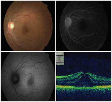 Female patient, 57years old. Who complains of gradual decrease in visual acuity in both eyes 1month of evolution. In this picture we can see a collage of the left eye, optical coherence tomography showed cystoid macular edema the fundus autofluorescence revealed hyper auto fluorescence on multi-spot pattern in both eyes and does not exhibit any signs of fluorescein leakage in the angiography fluorescein