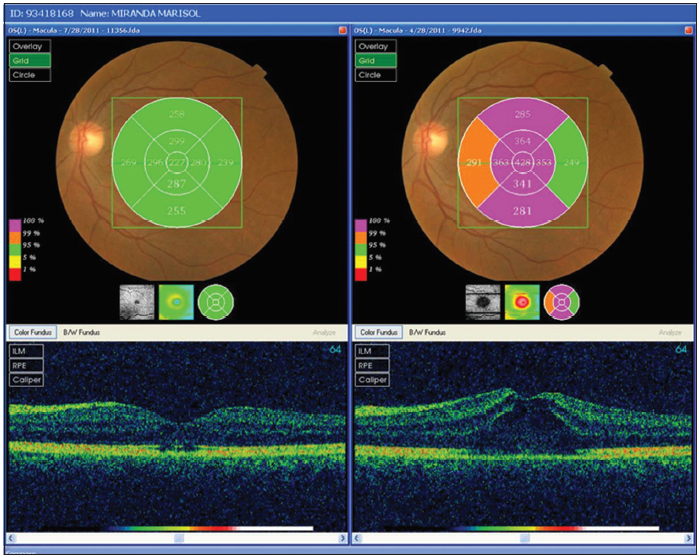 Female patient, 57years old. Who complains of gradual decrease in visual acuity in both eyes 1month of evolution. In this picture we can see after 8weeks in the optical coherence tomography showed a center normal thickness and a focal abnormality in the connection line between the inner and outer segments of photoreceptors