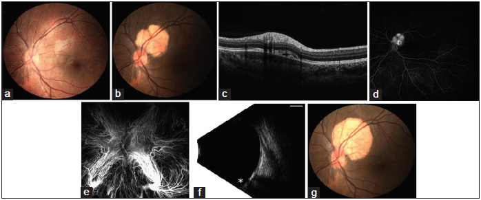 (a) A 16-year-old female presenting with a left eye peripapillary lesion. (a) Normal fundus photograph of the left eye 18 months before presentation. (b) Fundus photograph of the left eye on presentation demonstrating a circumscribed lesion superotemporal to the optic disc without hemorrhage, drusen, or orange pigment. (c) Optical coherence tomography demonstrates focal thickening and hyporeflectivity of the choroid, associated with trace subretinal fluid and retinal inner segment/outer segment disruption. (d) Fluorescein angiography at 9 min reveals staining of the lesion without leakage. (e) Indocyanine green angiography at 0.5 min reveals early hypocyanescence in the area of the lesion. (f) B-scan ultrasonography reveals the optic nerve (*) with the lesion that is 3.5 mm × 3.5 mm × 1 mm in height with high reflectivity causing marked shadowing of the orbit. Scale bar 5 mm, gain 57 dB, frequency 10 MHz. (g) The lesion demonstrated interval growth (in basal dimensions) at 5-month follow-up.