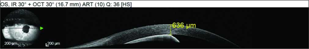 SD-OCT performed on the day of malignant glaucoma where atalamia, iridoendotelial contact, and increased corneal thickness are observed.